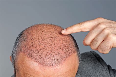 The Best hair transplant techniques .